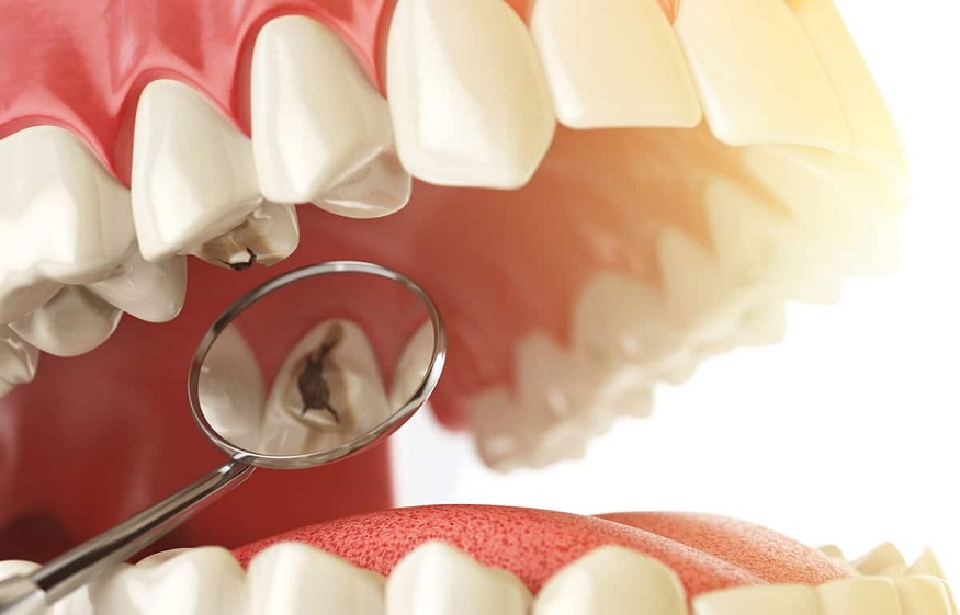 Is root canal covered by insurance in Singapore?