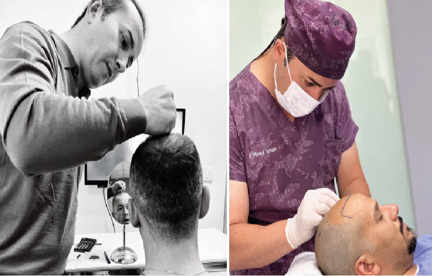 Turkey Hair Transplant Before and After Results