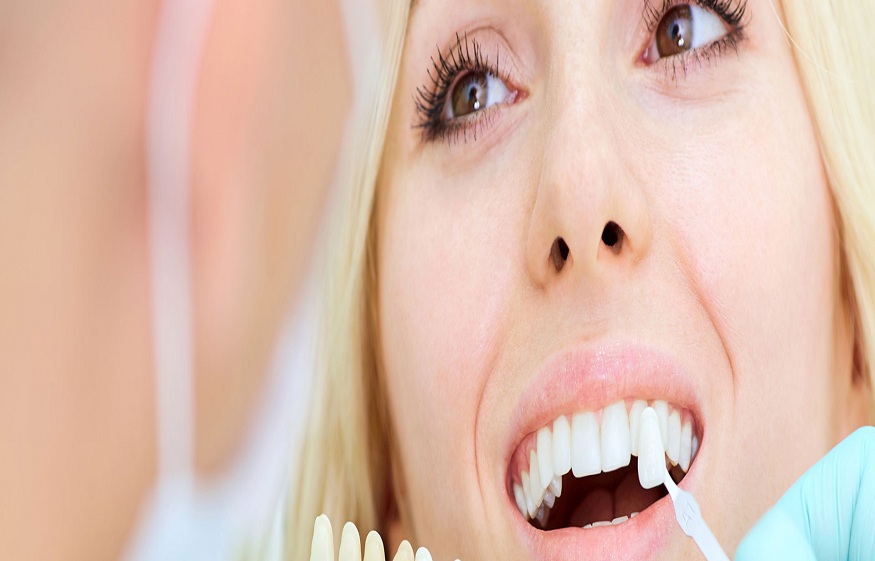 porcelain veneers centennial hills