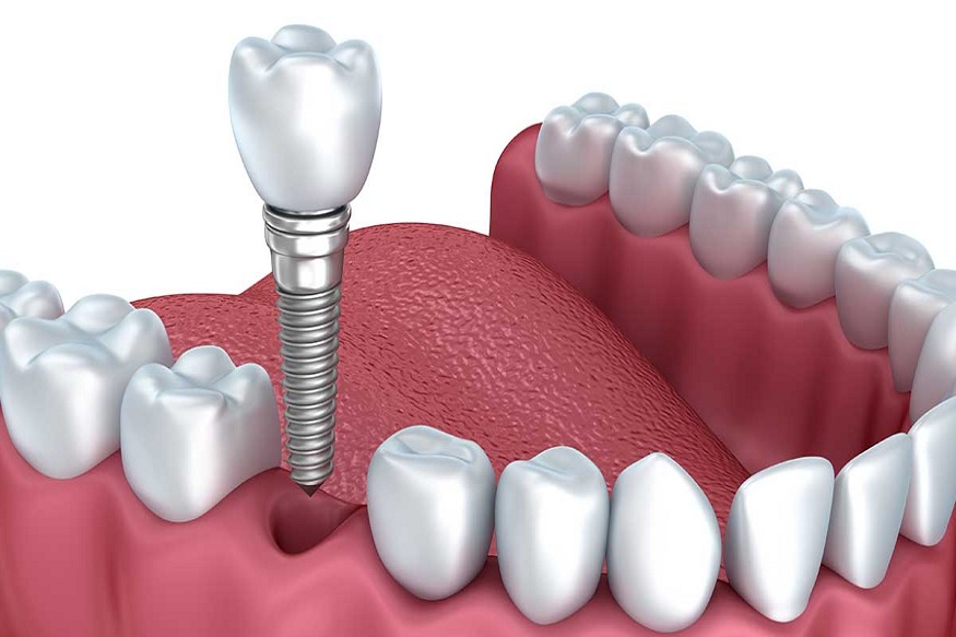 Improving Your Smile: What to Know About Cosmetic Dentistry in San Francisco